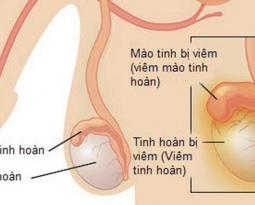 nguyen-nhan-trieu-chung-viem-tinh-hoan