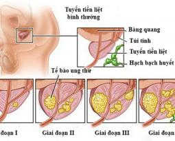 bieu-hien-viem-tuyen-tien-liet