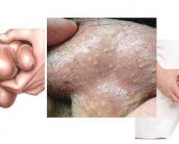 noi-mun-o-biu-tinh-hoan-ngua-ngay-la-trieu-chung-cua-benh-gi